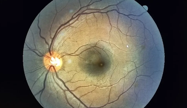 Potiguar de 22 anos tem lesão na retina após olhar para o eclipse solar sem proteção, aponta oftalmologista