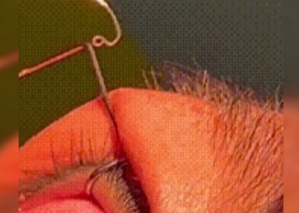 Médicos retiram 60 vermes dos olhos de mulher 