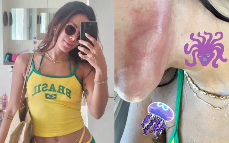 Anitta é queimada por água-viva em Ibiza: “Dor que nunca senti na vida”