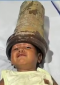 Menino de 2 anos fica com a cabeça presa em tubo de aço em Alagoas;Veja video