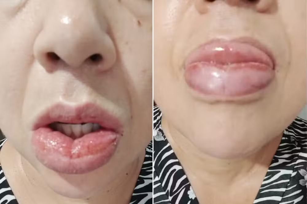 Educadora social, de 45 anos, sofre reação alérgica após uso de pasta de dente, em Miracatu (SP) — Foto: Arquivo pessoal