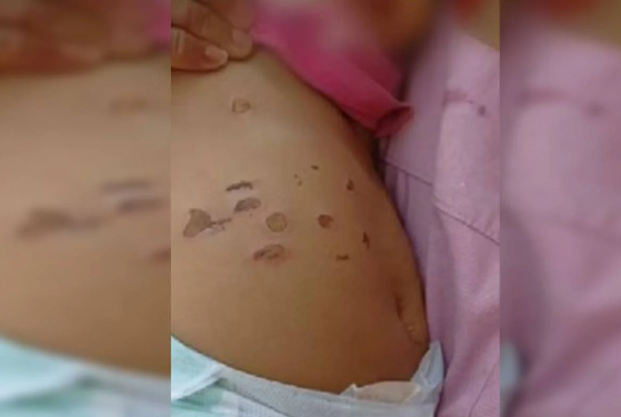 FireShot Capture 343 - Menina de 10 meses foi queimada com cigarros na barriga e nas perna_ - [www.metropoles.com].png