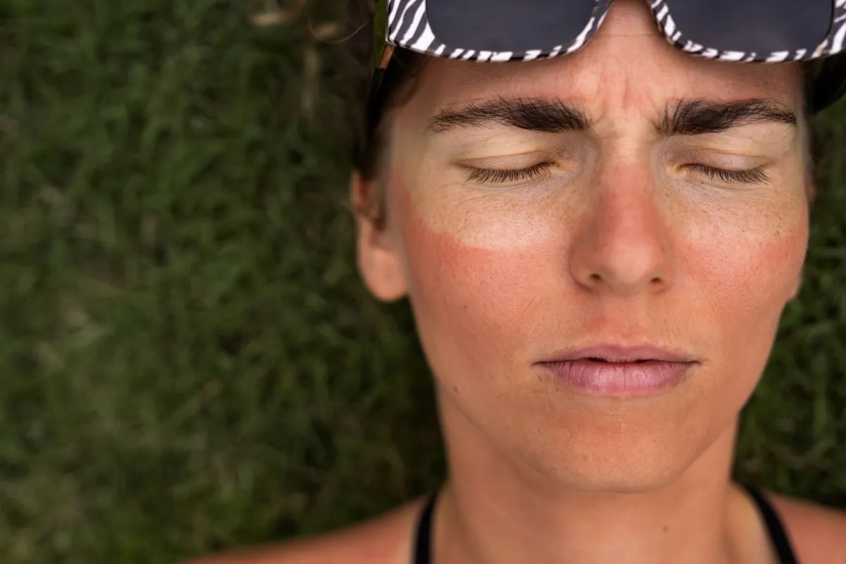 Exposição excessiva e sem proteção a luz solar pode aumentar o risco de câncer de pele, explica dermatologista  • Foto: Freepik