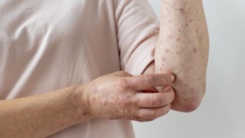 skin-allergy-person-s-arm-830x468.jpg