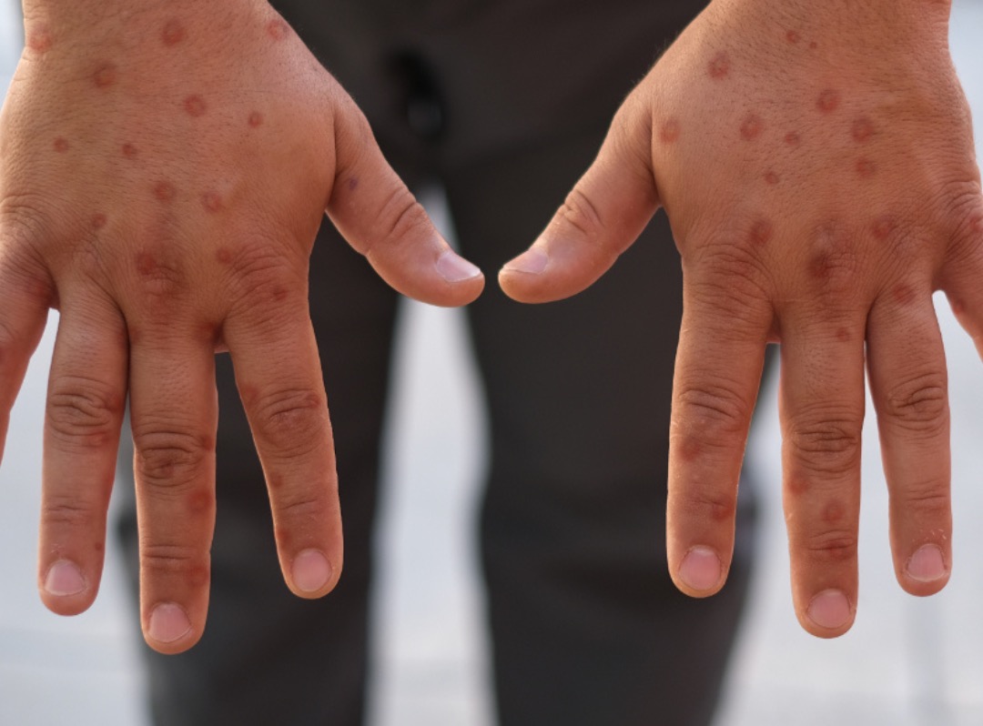 Mpox em Natal | Crédito: Foto: Reprodução/SMS