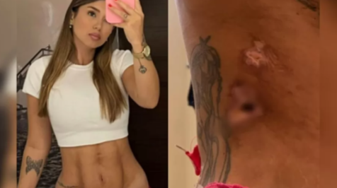 FireShot Capture 175 - Influencer tem corpo deformado e necroses após plásticas_ 'Entrei c_ - [www.uol.com.br].png