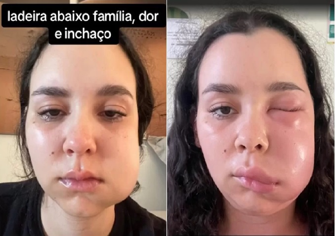 Jovem é internada com infecção após cirurgia para retirar os sisos