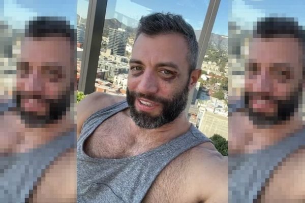 "Bateram na minha cabeça várias vezes", diz ator pornô gay espancado por seis homens