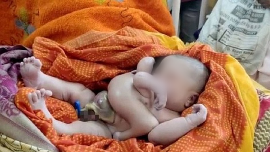 Bebê nascido com quatro braços e quatro pernas é tratado como divindade na Índia