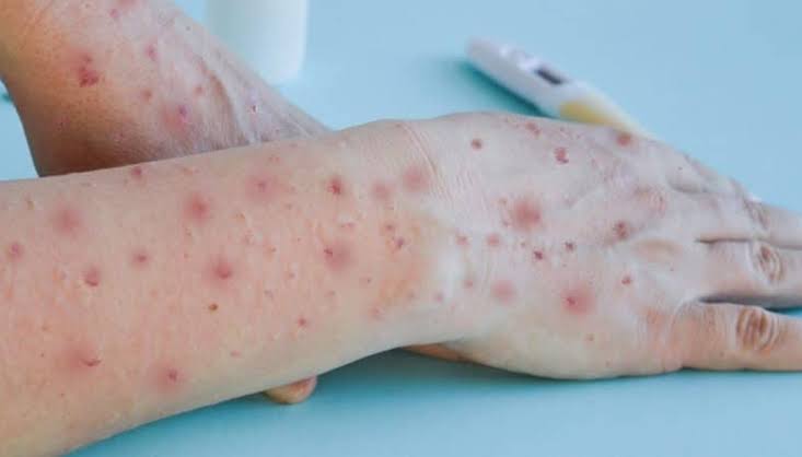 Natal tem primeiro caso confirmado de varíola dos macacos no Rio Grande do Norte