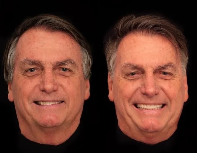 Bolsonaro faz harmonização facial por R$ 84 mil; veja resultado