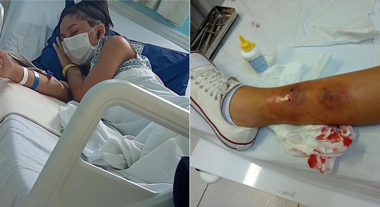 Menina de 14 anos é picada em atividade escolar e corre o risco de perder a perna