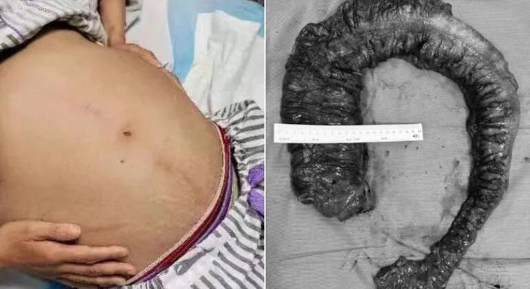 Cocô com 20 kg 'semelhante a píton' é retirado de intestino de mulher