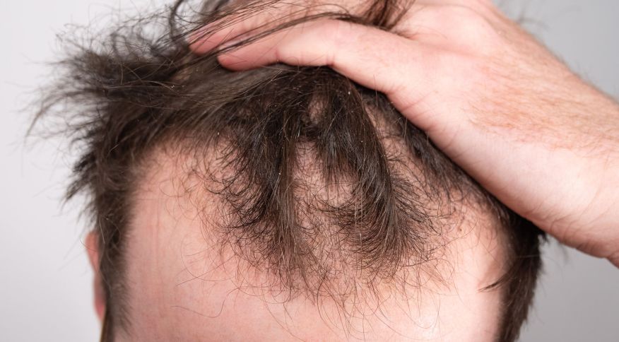 Pesquisa elenca melhores tratamentos para queda de cabelo masculino; veja