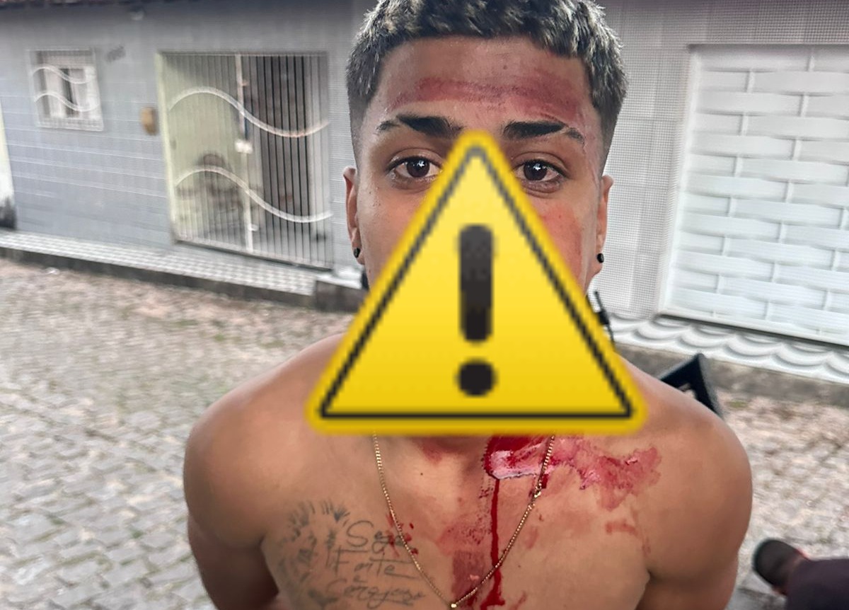 [VIDEO] Imagem forte: Veja como ficou jovem que levou tiro no rosto durante assalto