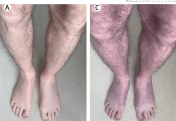 Pernas roxas é novo sintoma bizarro da covid descoberto por cientistas